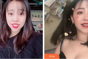 福州東南口腔醫(yī)院王一敏整形價(jià)格表附牙齒矯正案例展示