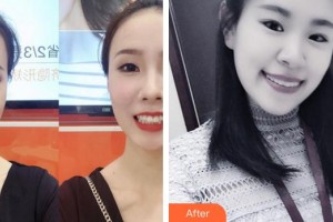 福州愛尚貝臣口腔門診部郭偉忠整形價(jià)格表附牙齒隱形矯正案例展示