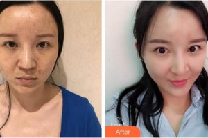 廈門(mén)華美名媛整形美容醫(yī)院李平珍整形價(jià)格表附自體脂肪面部填充案例展示