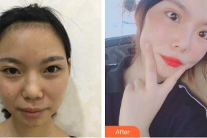 廈門(mén)美麗薇整形美容醫(yī)院金載勛整形價(jià)格表附眼部綜合案例展示