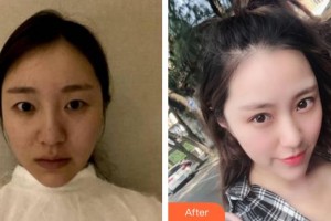 廈門張銘整醫(yī)療美容診所林平整形價(jià)格表附洛麗塔綜合美眼案例展示