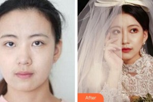 廈門海峽整形美容醫(yī)院賴炳招整形價(jià)格表附熱瑪吉案例展示