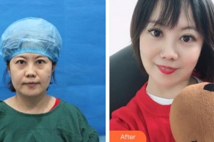 袁純新整形價(jià)格表附不開刀祛眼袋+自體脂肪填充淚案例展示