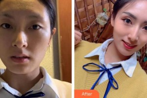 廈門莫琳娜醫(yī)療美容門診部張新合整形價(jià)格表附埋線提升案例展示