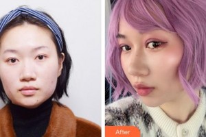 廈門修志夫整形美容醫(yī)院張寶譽(yù)整形價(jià)格表附埋線雙眼皮+去脂案例展示