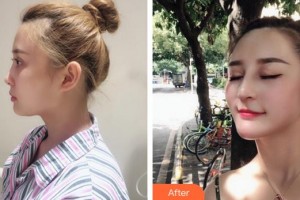 廈門海峽整形美容醫(yī)院童晉文整形價(jià)格表附肋軟骨隆鼻案例展示