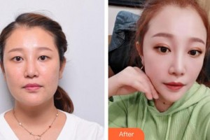 廈門大學(xué)附屬東南醫(yī)院燒傷整形科陳錦河整形價(jià)格表附埋線雙眼皮+去脂案例展示