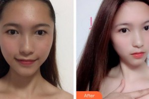 廈門海峽整形美容醫(yī)院張宏整形價(jià)格表附洛麗塔眼部手術(shù)案例展示