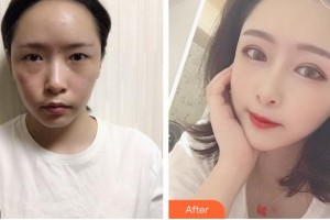 廈門莫琳娜醫(yī)療美容門診部陳石海整形價(jià)格表附新月桃花眼部手術(shù)案例展示