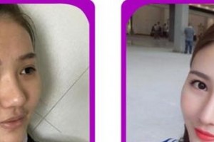 廈門華美名媛整形美容醫(yī)院賈虹整形價(jià)格表附鼻部手術(shù)案例展示