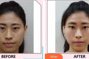 廈門莫琳娜醫(yī)療美容門診部宋維芳整形價格表附嫩膚案例展示