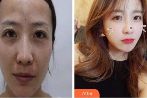 廈門海峽整形美容醫(yī)院王世爽整形價格表附激光美膚祛斑案例展示