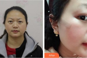 廈門大學(xué)附屬東南醫(yī)院燒傷整形科鄭慶亦整形價格表附面部疤痕修復(fù)案例展示