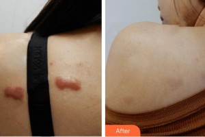 廈門大學(xué)附屬東南醫(yī)院燒傷整形科鄭健生整形價格表附疤痕增生去除疤痕案例展示