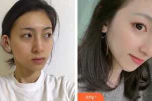 廈門大學(xué)附屬東南醫(yī)院燒傷整形科郭毅斌整形價格表附疤痕疙瘩案例展示