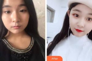 王根治整形價格表附爽妹子爽的鼻部手術(shù)案例展示
