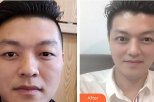 廈門莫琳娜醫(yī)療美容門診部林逸群整形價格表附即變男神，無關(guān)痛癢案例展示