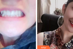 廣州醫(yī)學(xué)院口腔醫(yī)院張兆強(qiáng)住院醫(yī)師整形價(jià)格表附牙齒矯正案例展示