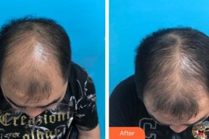 廈門銀河整形美容醫(yī)院呂巧云整形價格表附脫發(fā)調(diào)節(jié)重在堅持案例展示