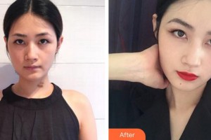 廈門新開元醫(yī)院整形美容中心李城杓整形價格表附增生疤痕案例展示