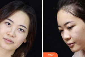 廈門海峽整形美容醫(yī)院曾美玲整形價格表附眼部整形案例展示