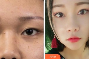 廈門海峽整形美容醫(yī)院劉歆整形價格表附眼部手術(shù)案例展示