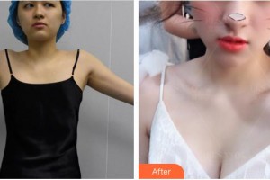 廈門大學附屬中山醫(yī)院整形美容科李鋒整形價格表附自體脂肪隆胸案例展示