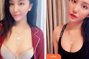 廈門福華醫(yī)療美容診所王建華整形價格表附濃縮豐胸真實案例展示