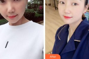 廈門修志夫整形美容醫(yī)院馮建苓整形價格表附肋軟骨隆鼻案例展示