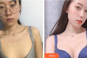 廈門市第二醫(yī)院美容整形外科中心盛建輝整形價格表附胸部整形案例展示