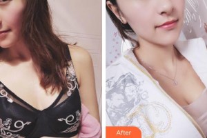 廈門天濟醫(yī)院醫(yī)療美容科朱文煌整形價格表附濃縮豐胸真實案例展示