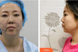 廈門黃巖整形美容醫(yī)院張皓林整形價格表附埋線提升案例展示