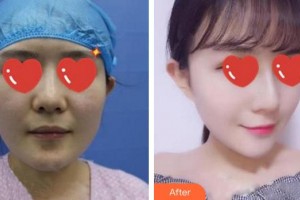 廈門美萊醫(yī)療美容醫(yī)院王忠堂整形價格表附	自體脂肪填充多方面部案例展示