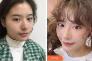 廈門美萊醫(yī)療美容醫(yī)院劉乃仁整形價格表附“熱瑪吉”多方面部 緊致提升案例展示