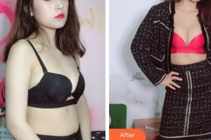 廈門薇格整形外科門診部崔元碩整形價格表附濃縮豐胸真實案例展示