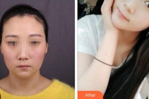 廈門黃巖整形美容醫(yī)院劉妍希住院醫(yī)師整形價(jià)格表附埋線提升案例展示