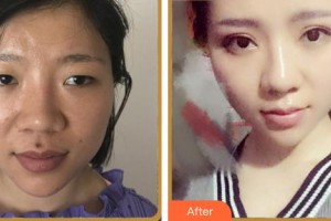 廈門修志夫整形美容醫(yī)院邰洪武整形價(jià)格表附眼部多項(xiàng)案例展示