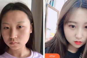 廈門海峽整形美容醫(yī)院何海霞整形價(jià)格表附埋線提升案例展示