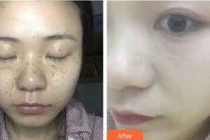 廈門華美名媛整形美容醫(yī)院張芳媛整形價(jià)格表附激光美膚激光案例展示