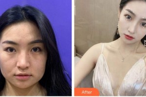 廈門華美名媛整形美容醫(yī)院于璇整形價(jià)格表附"熱瑪吉"年輕化緊致案例展示