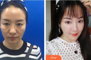 廈門華美名媛整形美容醫(yī)院陳秋珍整形價(jià)格表附埋線提升案例展示