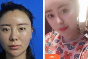 廈門華美名媛整形美容醫(yī)院姜靜整形價(jià)格表附抗衰年輕化熱瑪吉案例案例展示