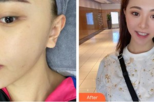 廈門臉博士整形醫(yī)院周虹整形價(jià)格表附祛斑案例展示