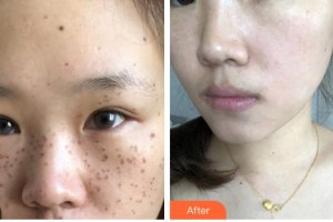 廈門臉博士整形醫(yī)院林達(dá)敏整形價(jià)格表附超激光美膚祛斑案例展示