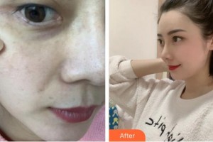 廈門福華醫(yī)療美容診所金貴香整形價(jià)格表附超激光美膚祛斑案例展示