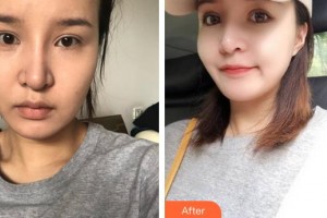 廈門華美名媛整形美容醫(yī)院張曉英整形價(jià)格表附埋線提升案例展示