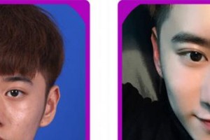 廈門修志夫整形美容醫(yī)院周璟整形價(jià)格表附隆鼻案例展示