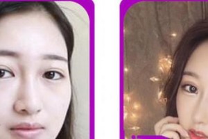 廈門海明醫(yī)療美容診所李萬福整形價(jià)格表附鼻部綜合案例展示