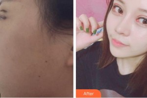 廈門海明醫(yī)療美容診所林偉亮整形價(jià)格表附鼻部案例展示