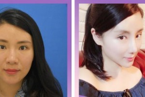 廈門美麗薇整形美容醫(yī)院吳原碩整形價(jià)格表附經(jīng)典美鼻部手術(shù) 多方位美鼻案例展示